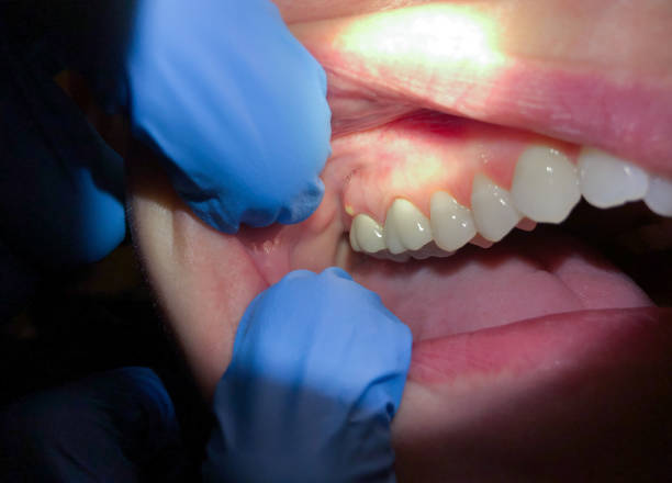 Best Urgent Tooth Repair  in Chain Lake, WA