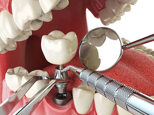 Best Knocked-Out Tooth Emergency  in Chain Lake, WA